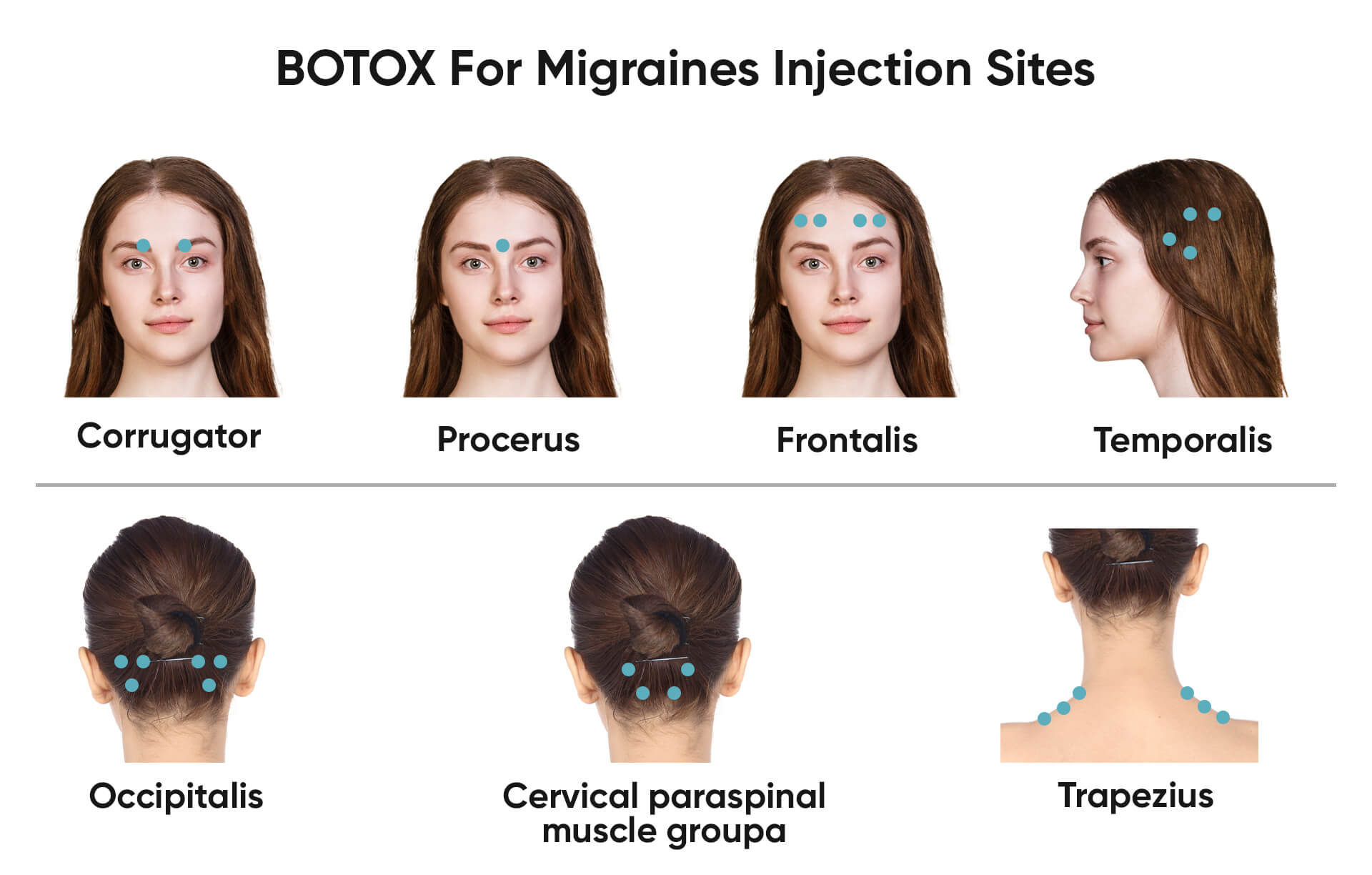 Botox Treatment in Vietnam: Reduce Wrinkles for a Youthful Appearance 7 Botox Treatment in vietnam 5