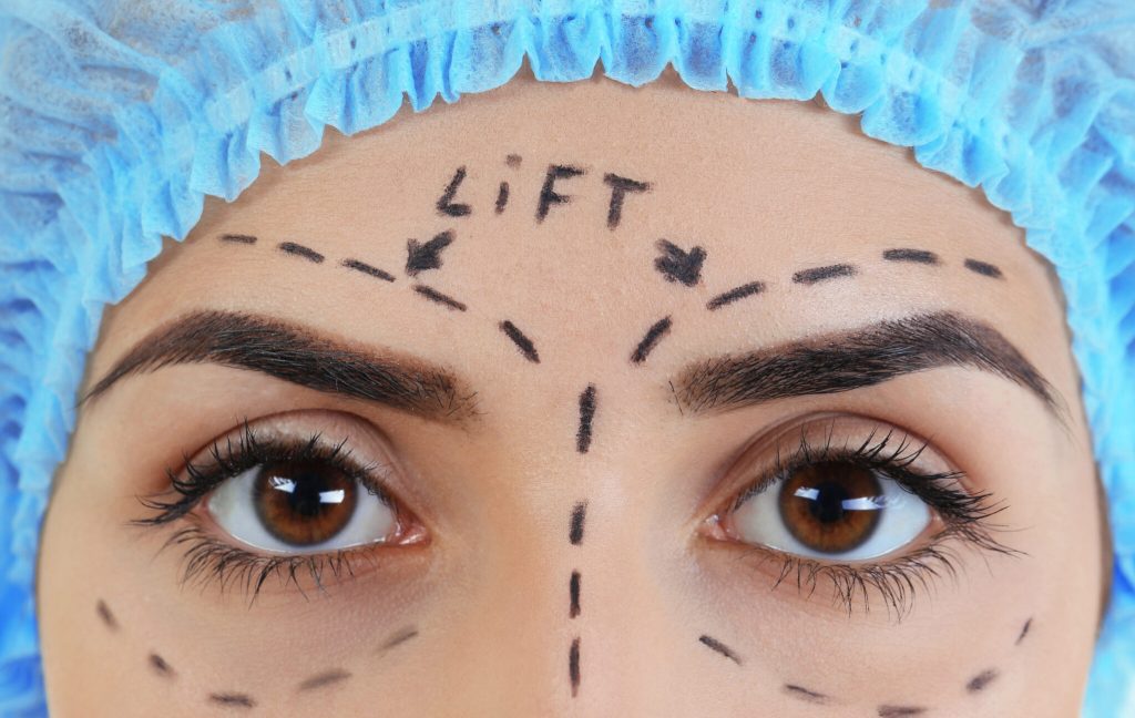 Brow Lift in Vietnam 1