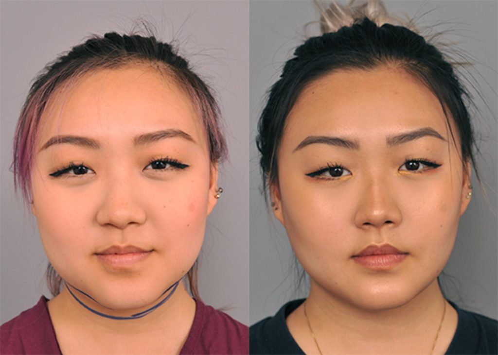 Buccal Fat Removal in Vietnam 1