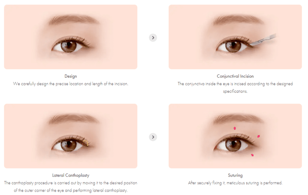 Canthoplasty in Vietnam 1