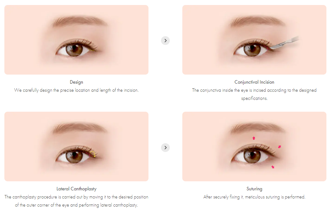 Canthoplasty in Vietnam: Reshape and Enhance Eye Definition 3 Canthoplasty in Vietnam: Reshape and Enhance Eye Definition
