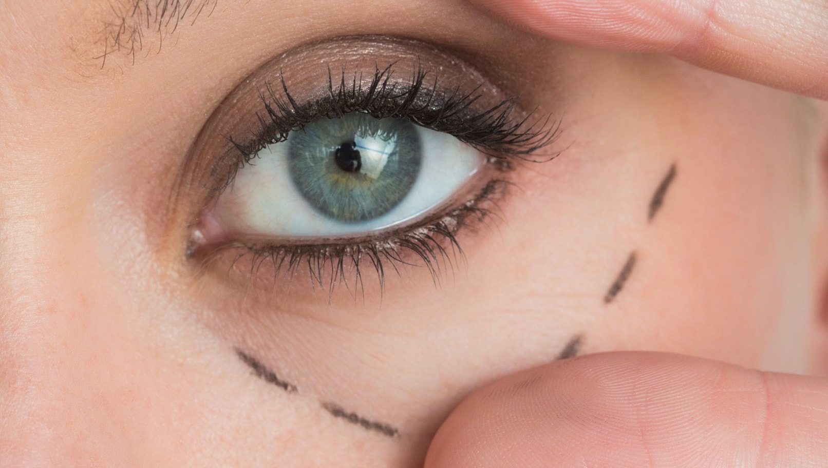 Eye Bag Removal in Vietnam: Eliminate Tired-Looking Eyes Effectively 4 Canthoplasty in Vietnam 5