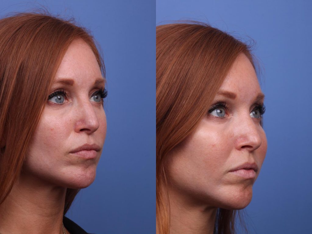 Cheek Augmentation in Vietnam 1