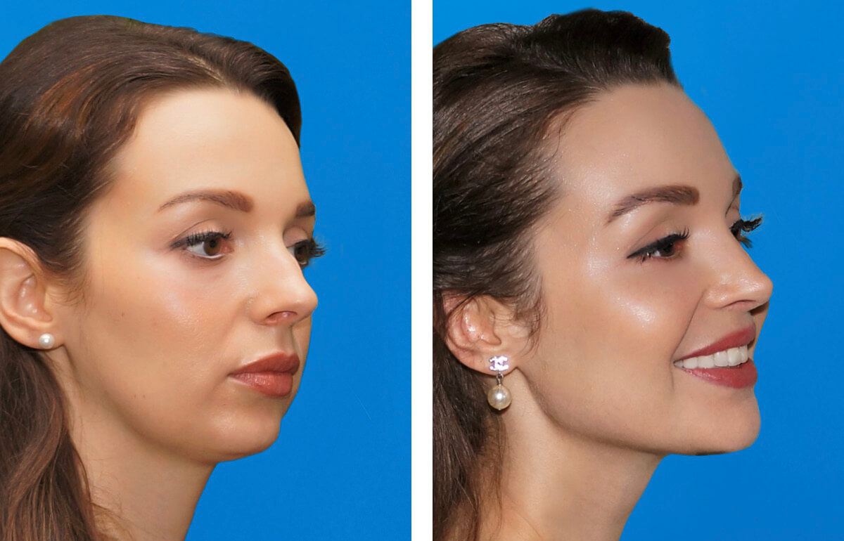 Cheek Augmentation in Vietnam: Create Softer and More Contoured Features 4 Cheek Augmentation in Vietnam 2