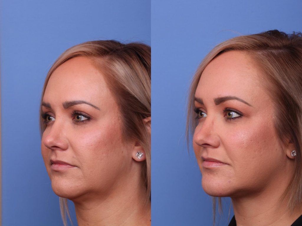 Chin Augmentation in Vietnam 1