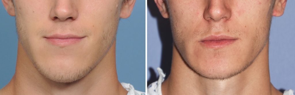 Chin Reduction Surgery in Vietnam 1