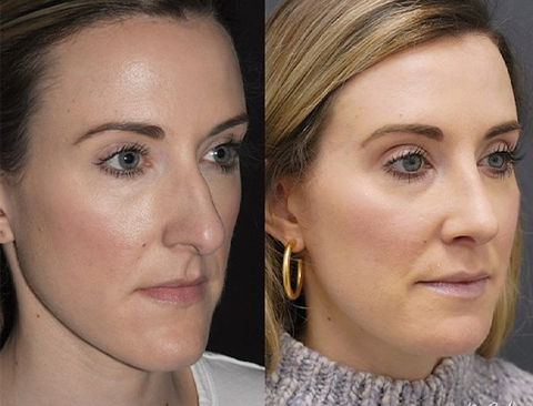 Chin Reduction Surgery in Vietnam: Create a Softer and More Proportional Profile 4 Chin Reduction Surgery in Vietnam 2