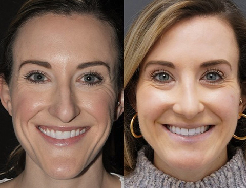 Chin Reduction Surgery in Vietnam: Create a Softer and More Proportional Profile 5 Chin Reduction Surgery in Vietnam 3