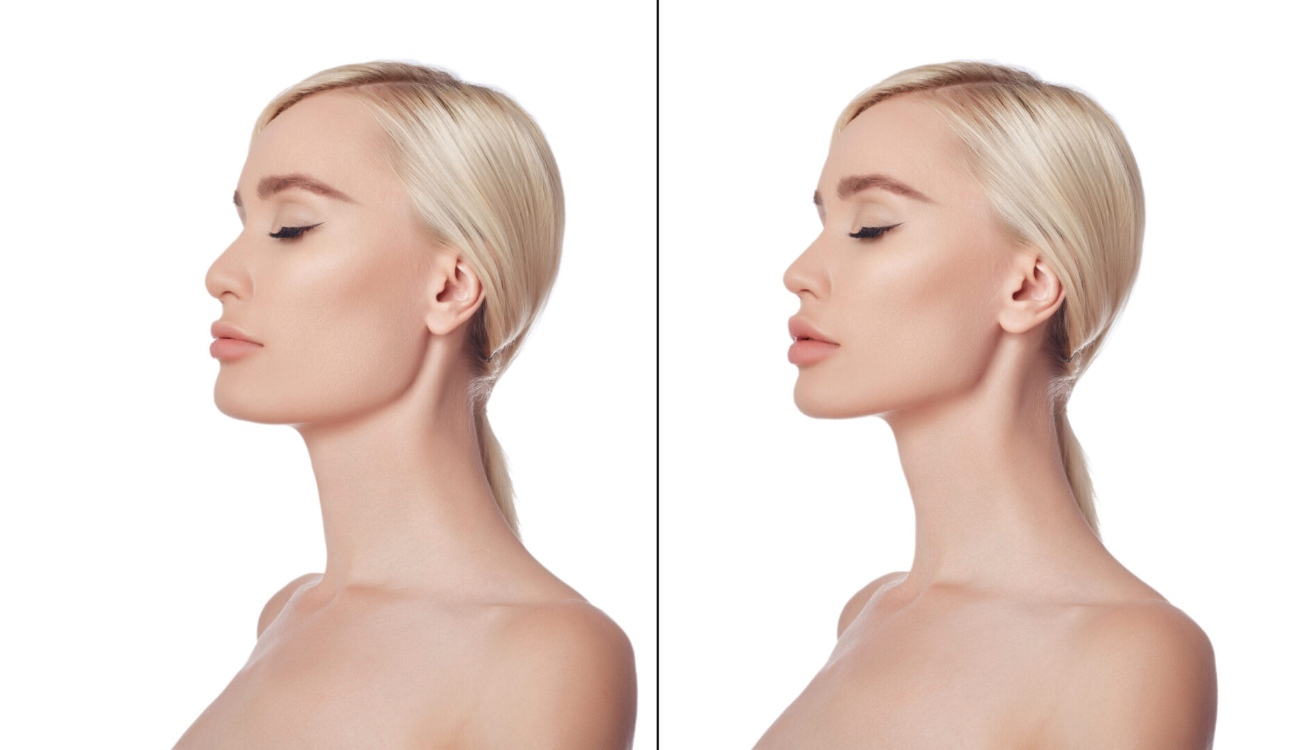Chin Reduction Surgery in Vietnam: Create a Softer and More Proportional Profile 8 Chin Reduction Surgery in Vietnam 4