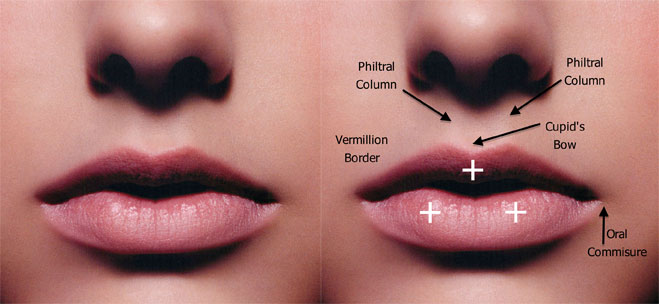 Cupid Bow Lip Surgery in Vietnam: Define Elegant and Well-Shaped Lips 4 Cupid Bow Lip Surgery in Vietnam 3