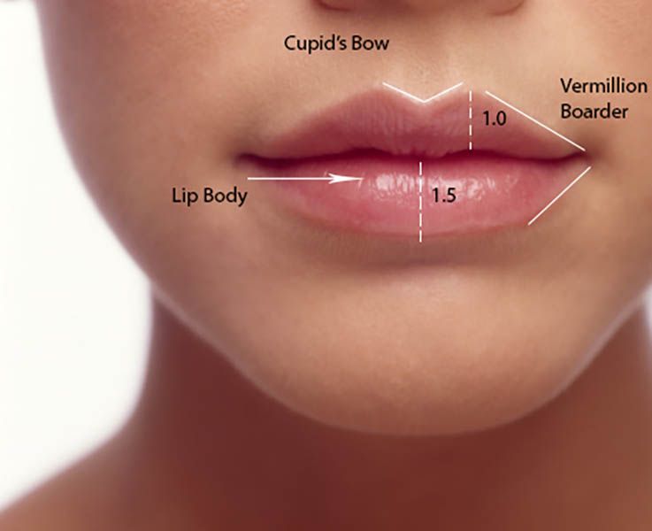 Cupid Bow Lip Surgery in Vietnam: Define Elegant and Well-Shaped Lips 6 Cupid Bow Lip Surgery in Vietnam 5