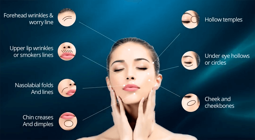 Dermal Filler Treatment in Vietnam: Restore Volume and Enhance Facial Features 3 Dermal Filler Treatment in Vietnam 1