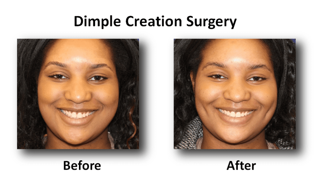 Dimple Creation in Vietnam 1