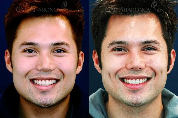 Dimple Creation in Vietnam: Add a Charming and Youthful Touch 5 Dimple Creation in Vietnam 3