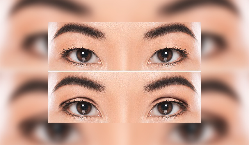 Blepharoplasty in Vietnam: Rejuvenate Your Eyes with Precision Surgery 5 Double Eyelid Creation in Vietnam 1