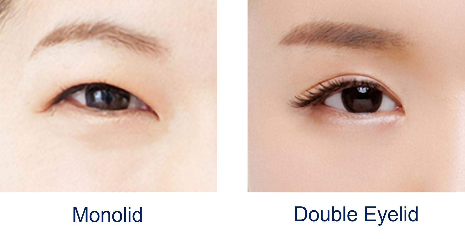 Double Eyelid Creation in Vietnam: Achieve Bigger, Brighter Eyes 5 Double Eyelid Creation in Vietnam 3