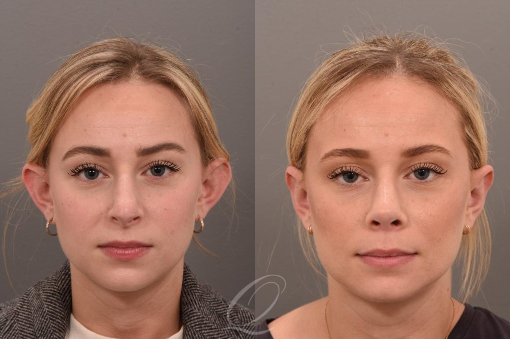 Ear Surgery Otoplasty in Vietnam 1