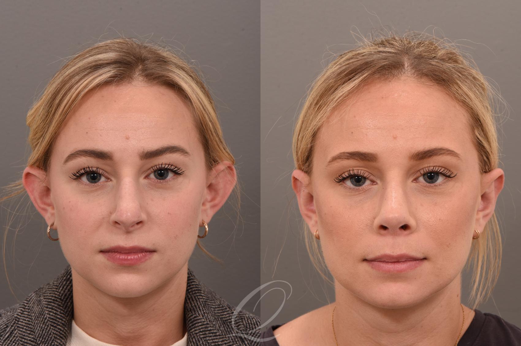 Ear Surgery (Otoplasty) in Vietnam: Correct Ear Shape for Better Balance 3 Ear Surgery (Otoplasty) in Vietnam: Correct Ear Shape for Better Balance