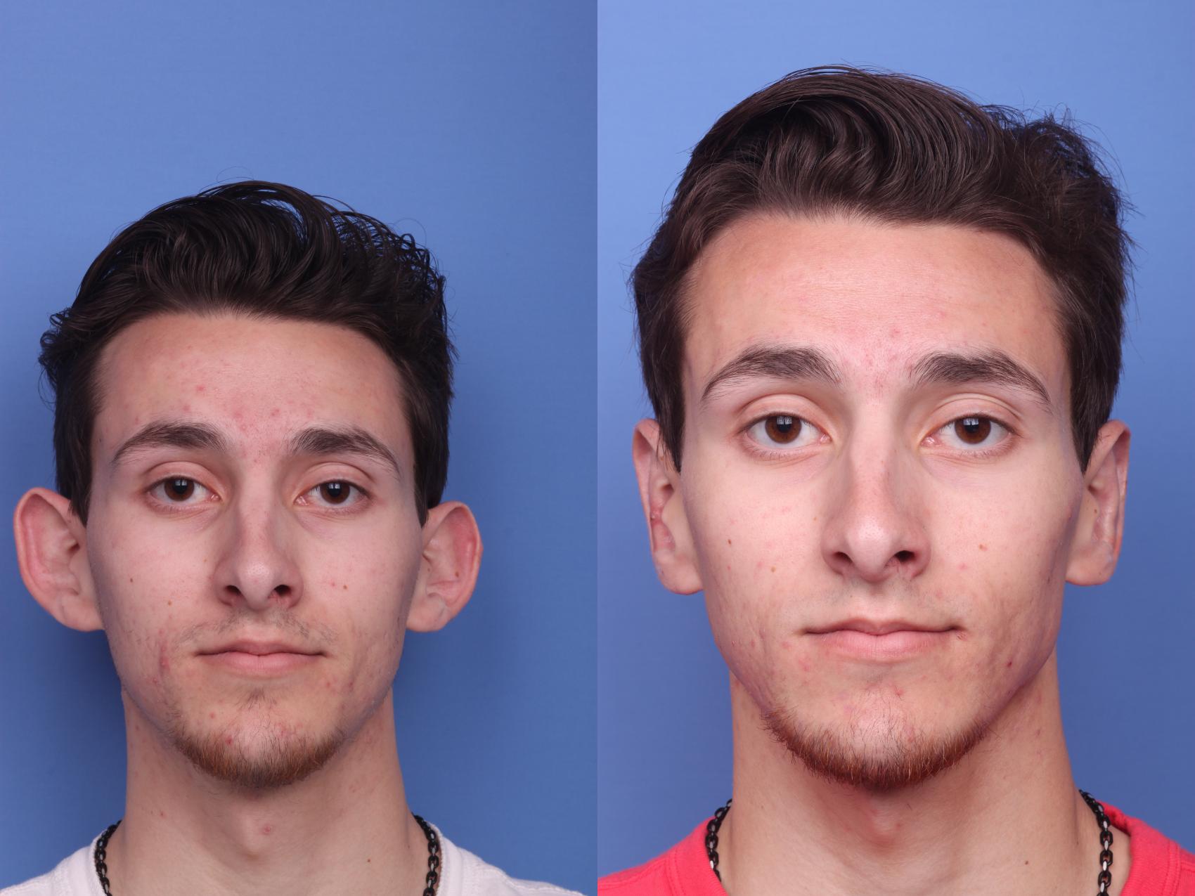 Ear Surgery (Otoplasty) in Vietnam: Correct Ear Shape for Better Balance 6 Ear Surgery Otoplasty in Vietnam 4