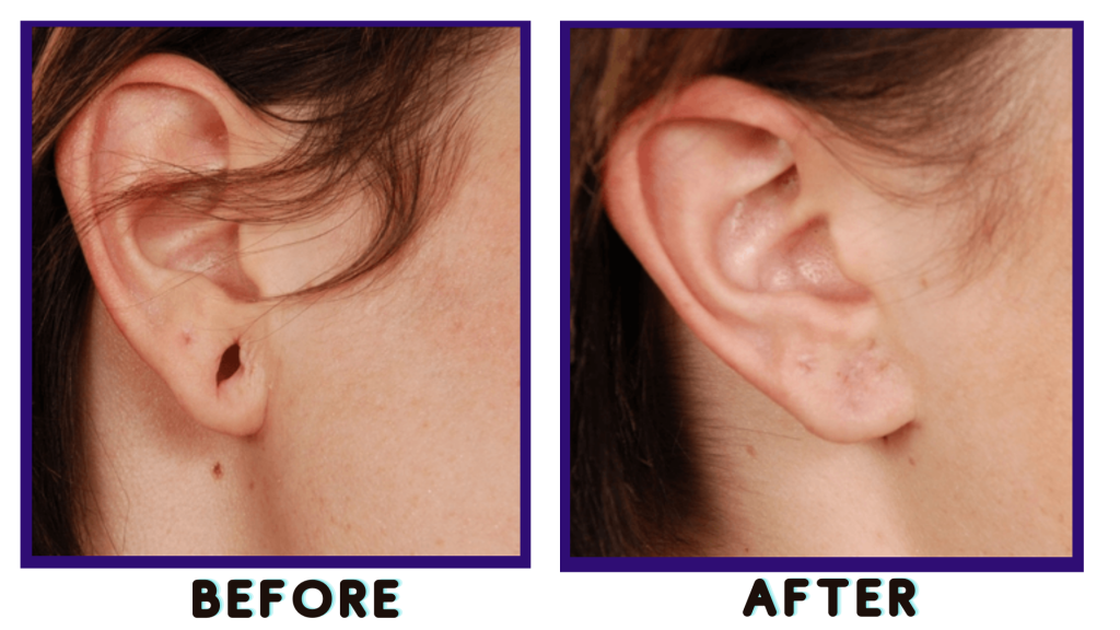 Earlobe Repair in Vietnam: Restore Torn or Stretched Earlobes Naturally 3 Earlobe Repair in Vietnam 1