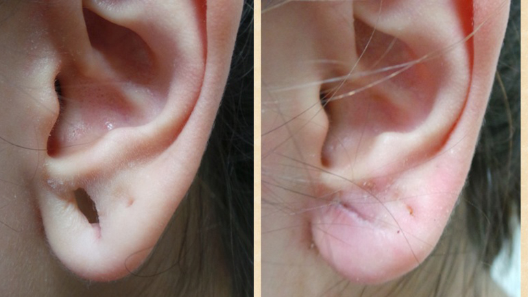 Earlobe Repair in Vietnam: Restore Torn or Stretched Earlobes Naturally 4 Earlobe Repair in Vietnam 2