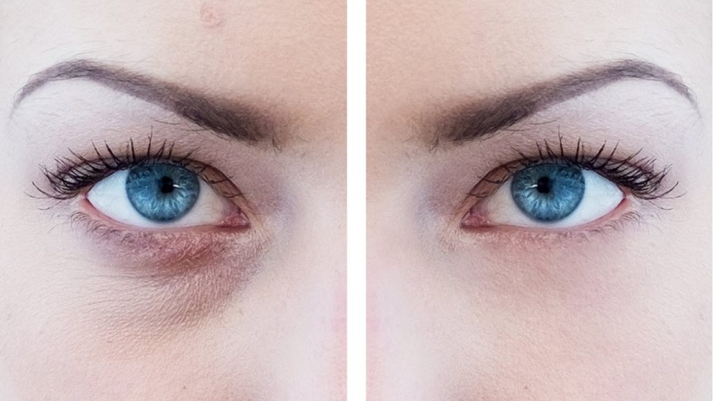 Eye Bag Removal in Vietnam 2