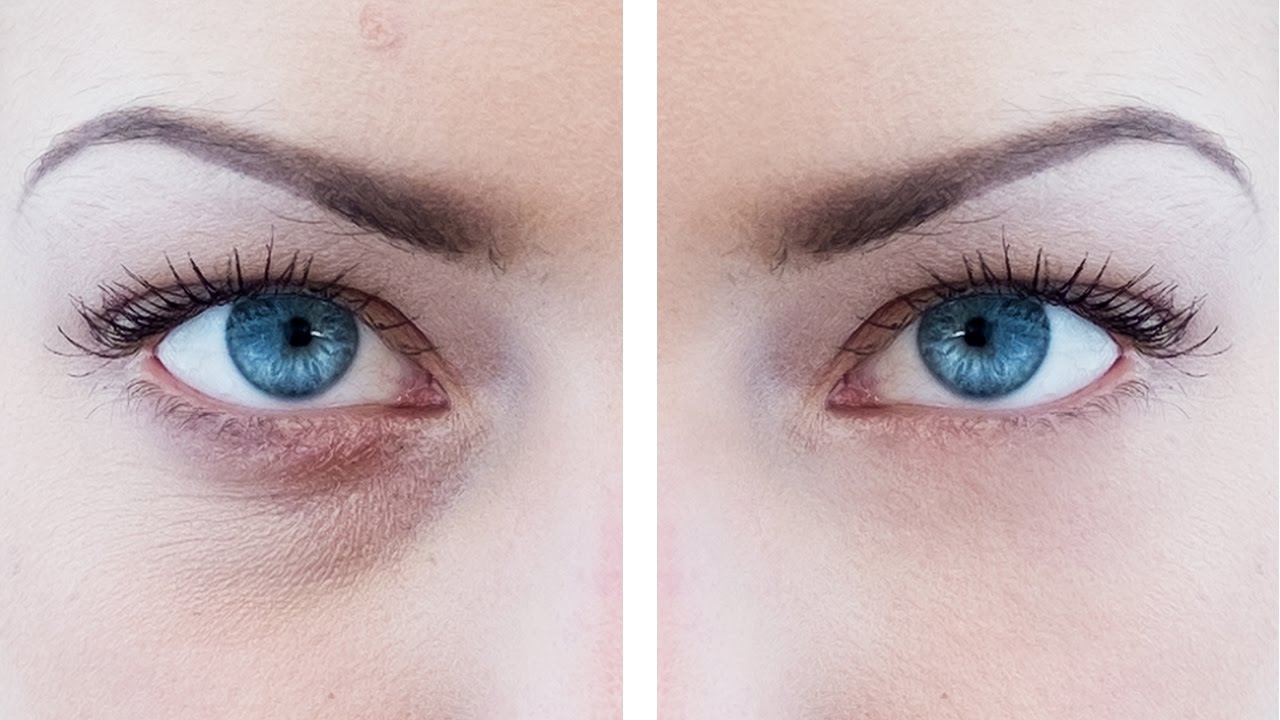 Eye Bag Removal in Vietnam: Eliminate Tired-Looking Eyes Effectively 3 Eye Bag Removal in Vietnam: Eliminate Tired-Looking Eyes Effectively
