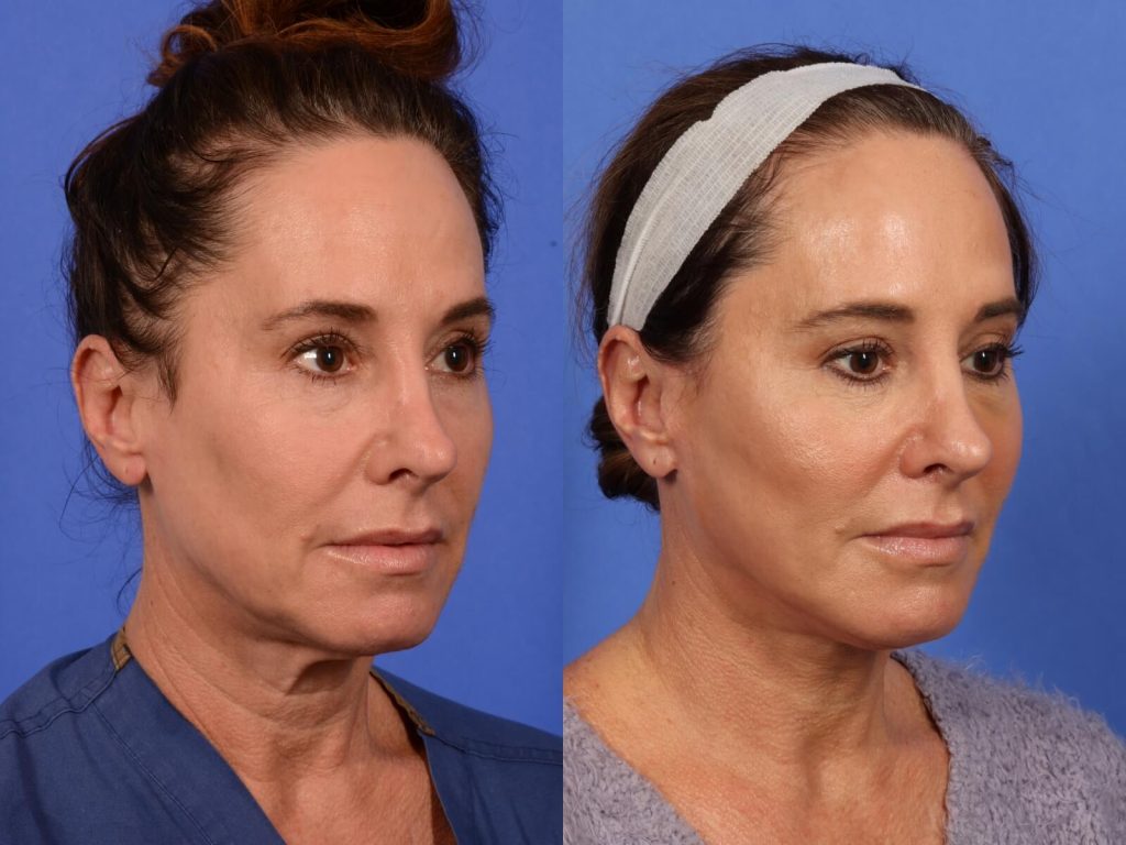 Facelift Surgery in Vietnam 1