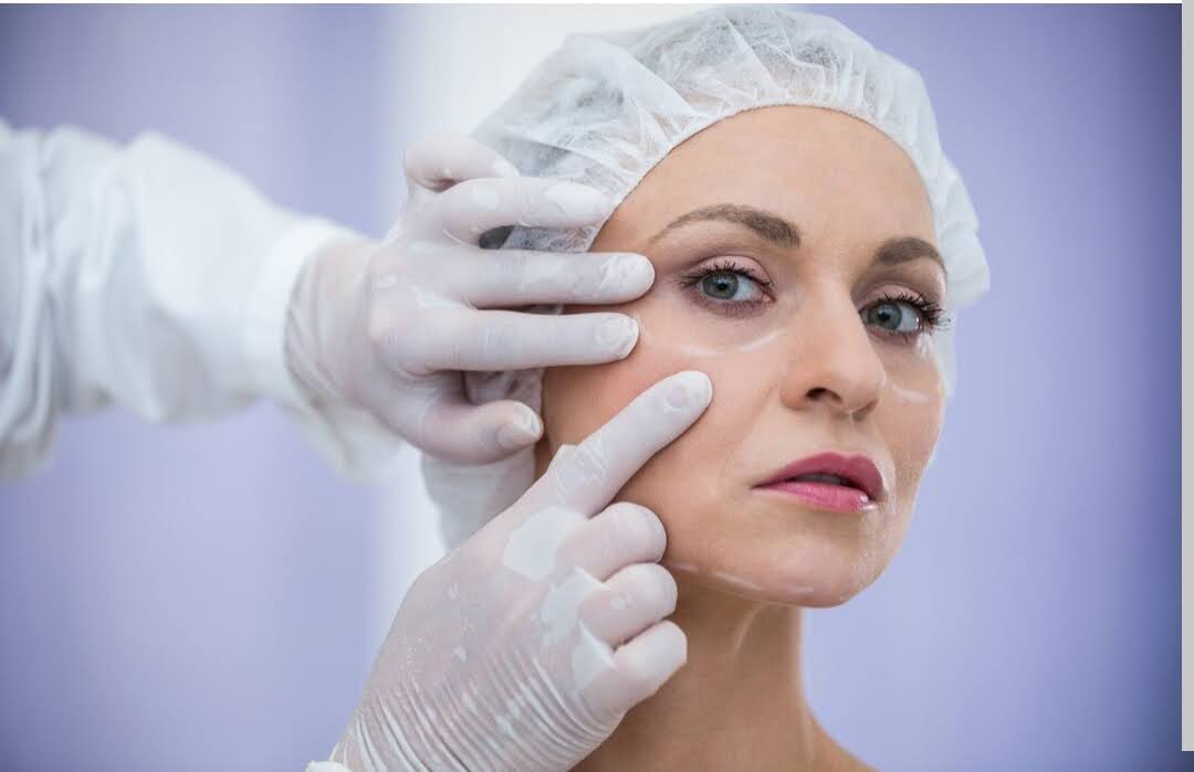 Mini Facelift in Vietnam: Subtle Lifting with Natural Results 6 Facelift Surgery in Vietnam 4