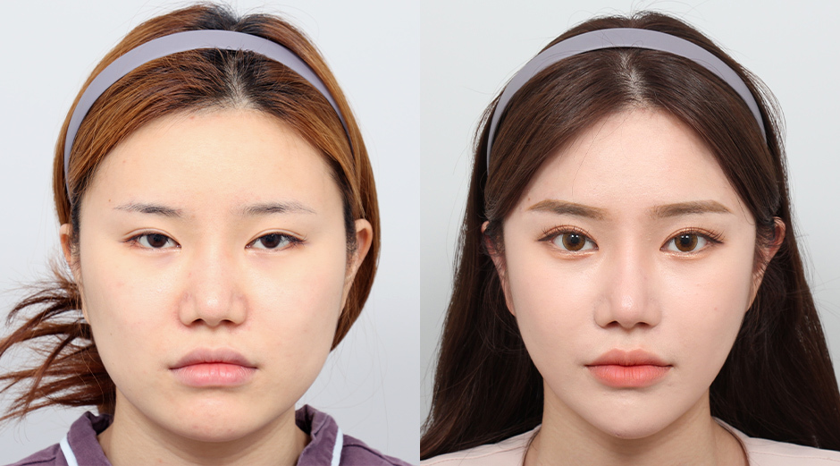 Facial Contouring Surgery in Vietnam: Achieve a Harmonious and Sculpted Face 3 Facial Contouring Surgery in Vietnam: Achieve a Harmonious and Sculpted Face