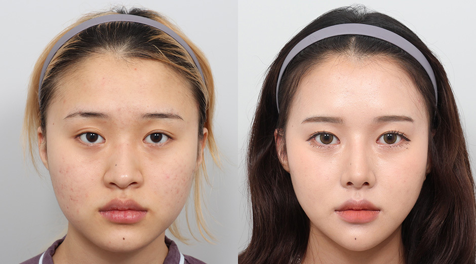 Facial Contouring Surgery in Vietnam: Achieve a Harmonious and Sculpted Face 4 Facial Contouring Surgery in Vietnam 2