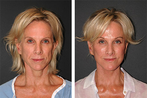 Facial Fat Transfer in Vietnam: Restore Volume for a Youthful, Natural Look 3 Facial Fat Transfer in Vietnam: Restore Volume for a Youthful, Natural Look