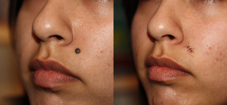 Facial Mole Removal in Vietnam: Achieve Clearer and Smoother Skin 3 Facial Mole Removal in Vietnam: Achieve Clearer and Smoother Skin