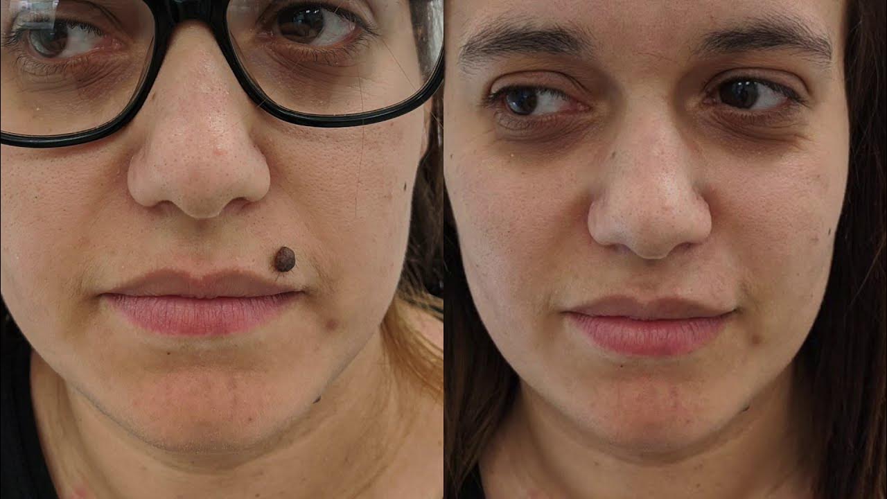 Facial Mole Removal in Vietnam: Achieve Clearer and Smoother Skin 4 Facial Mole Removal in Vietnam 2