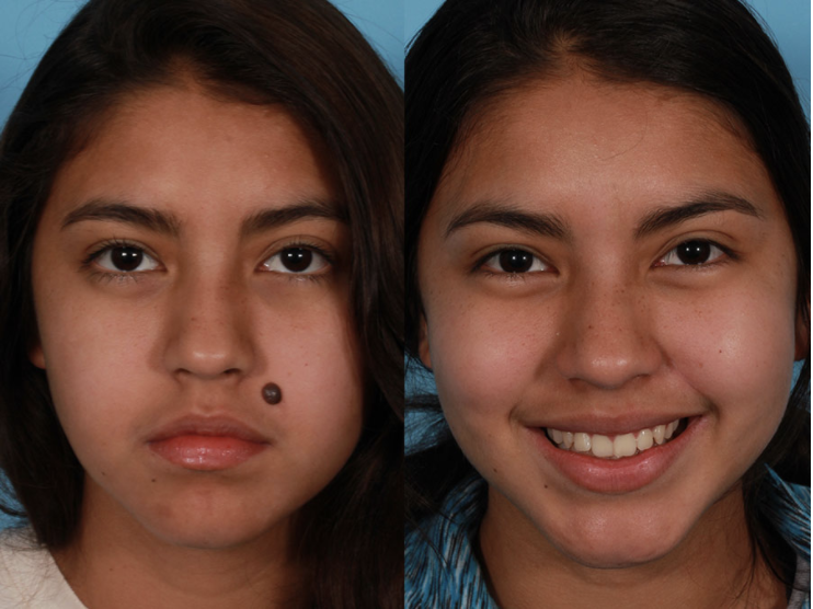 Facial Mole Removal in Vietnam: Achieve Clearer and Smoother Skin 5 Facial Mole Removal in Vietnam 3