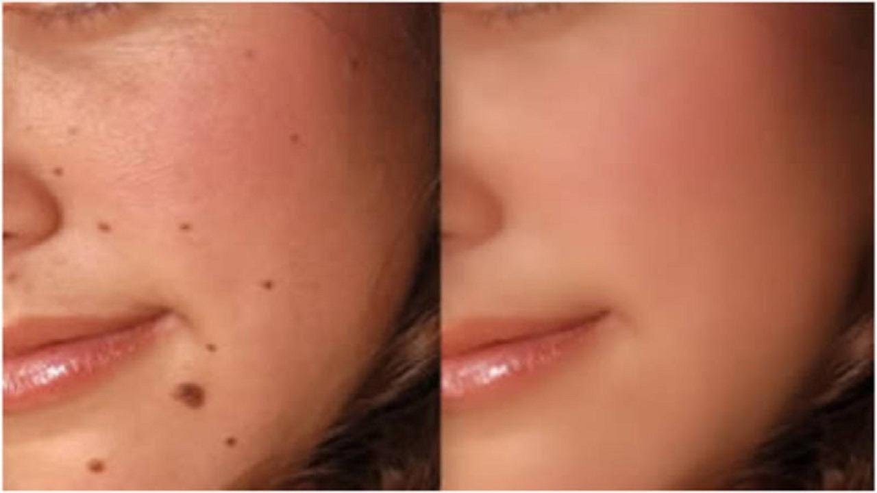 Facial Mole Removal in Vietnam: Achieve Clearer and Smoother Skin 6 Facial Mole Removal in Vietnam 4