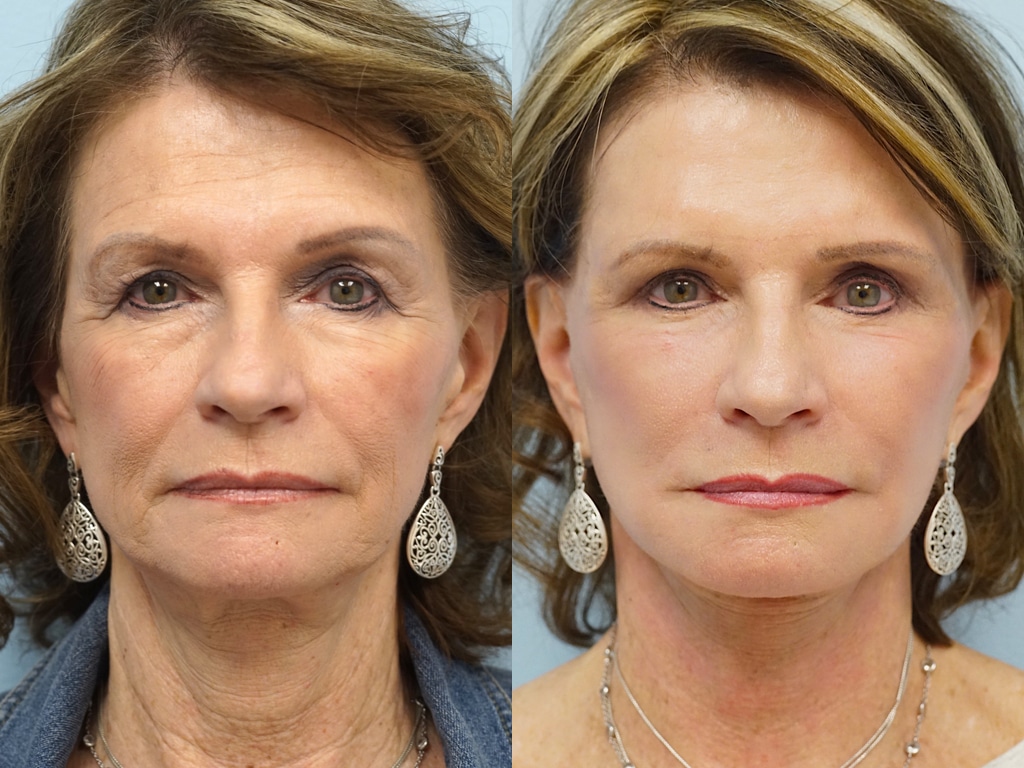 Fat Grafting to Face in Vietnam: Restore Volume for a Youthful Appearance 3 Fat Grafting to Face in Vietnam: Restore Volume for a Youthful Appearance