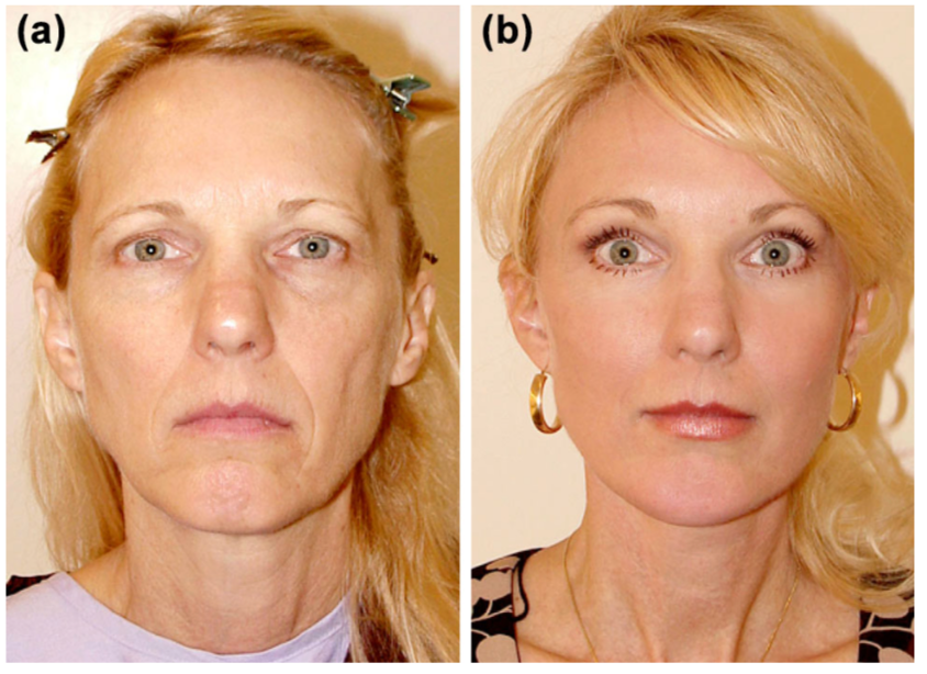 Facial Fat Transfer in Vietnam: Restore Volume for a Youthful, Natural Look 6 Fat Grafting to Face in Vietnam 3