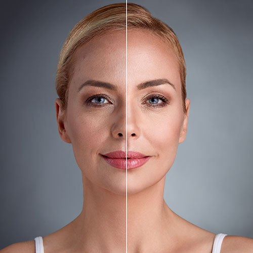 Facial Fat Transfer in Vietnam: Restore Volume for a Youthful, Natural Look 5 Fat Grafting to Face in Vietnam 4