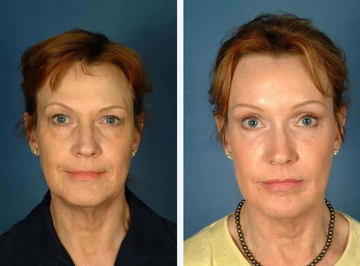 Forehead Lift Surgery in Vietnam – Smooth Wrinkles and Elevate Your Look 5 Forehead Lift Surgery in Vietnam 3