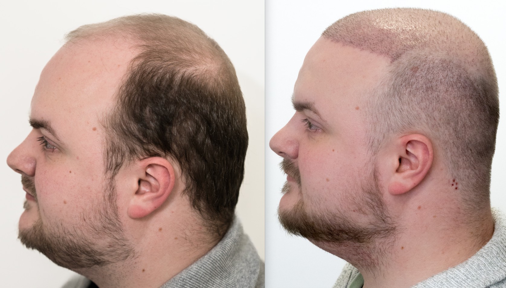 Hair Transplant in Vietnam: Permanent Solutions for Natural Hair Growth 3 Hair Transplant in Vietnam 1