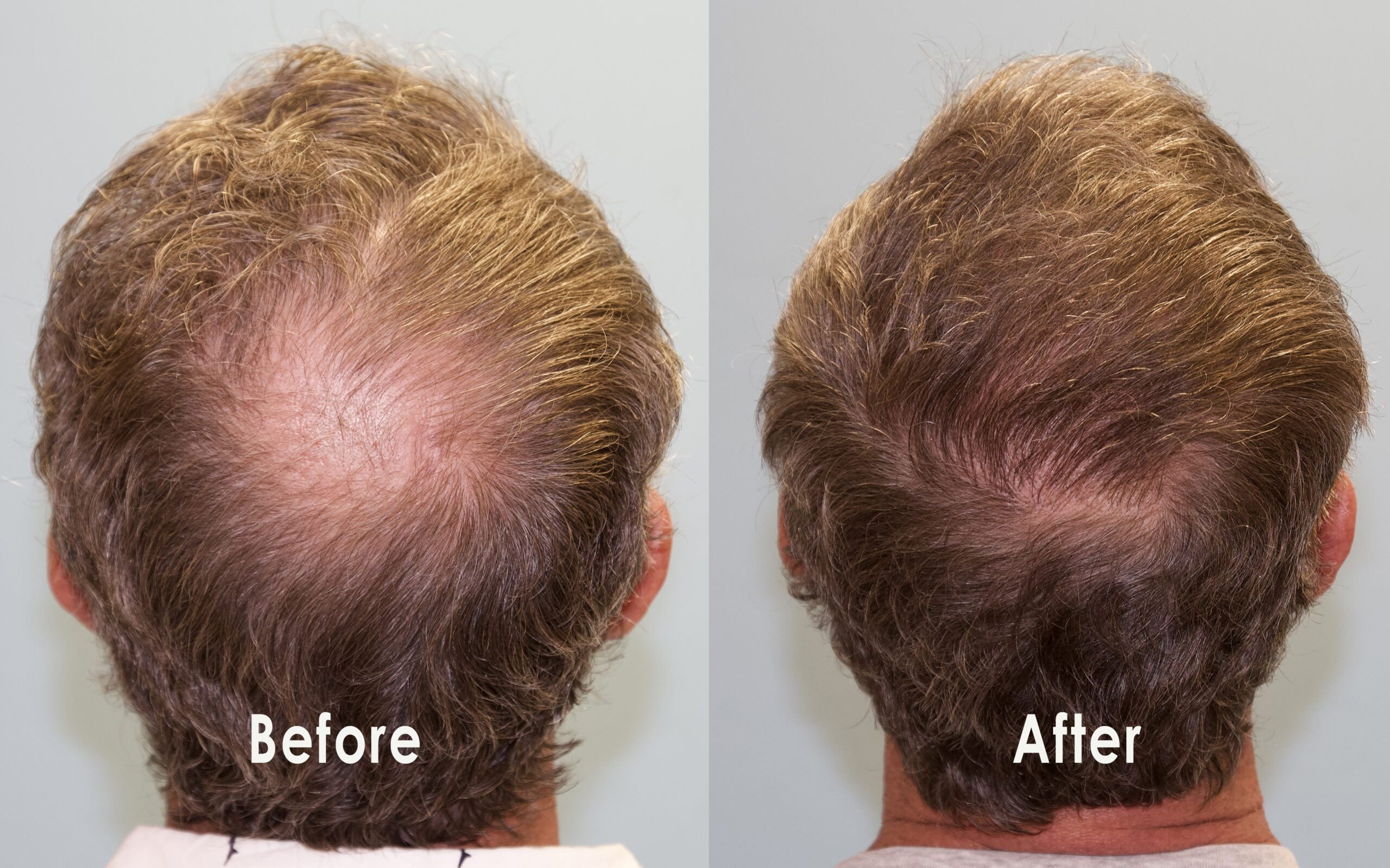 Hair Transplant in Vietnam: Permanent Solutions for Natural Hair Growth 4 Hair Transplant in Vietnam 2