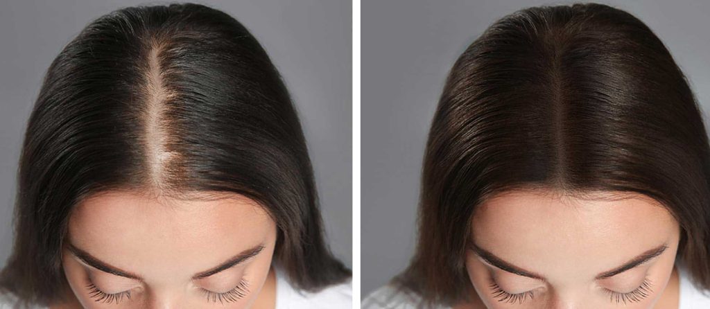 Hair Transplant in Vietnam 4