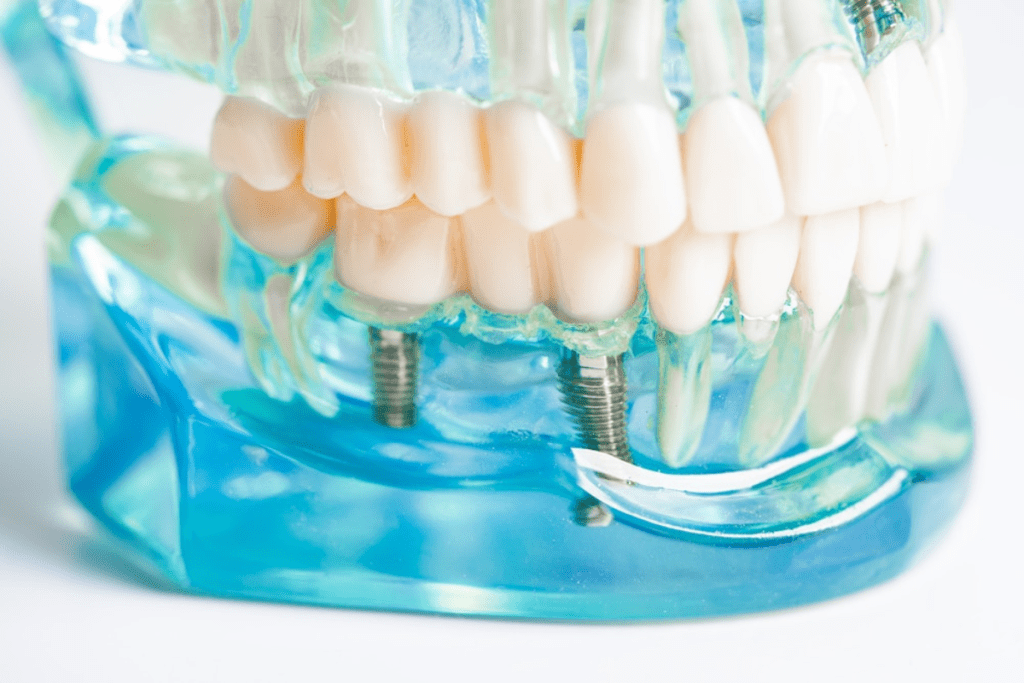 Types of Zirconia Porcelain Teeth in Vietnam. Types of Zirconia Porcelain Teeth in Vietnam. Types of Zirconia Porcelain Teeth in Vietnam