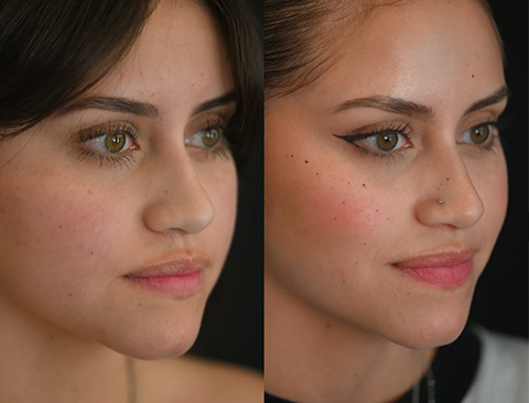 Smile Lip Lift in Vietnam: Enhance Your Smile with Subtle Elegance 7 Jaw Reduction in Vietnam 1