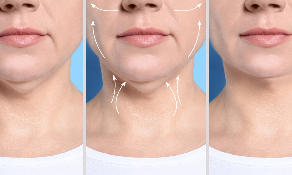 Jaw Reduction in Vietnam: Facial Contouring for a Harmonious Look 4 Jaw Reduction in Vietnam 2
