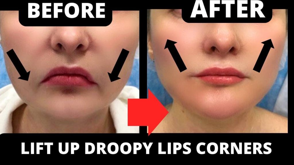 Lip Corner Lift in Vietnam 1