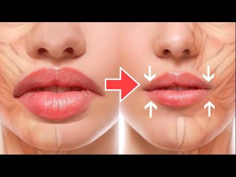 Lip Corner Lift in Vietnam: Turn Downturned Lips into a Pleasant Smile 7 Lip Corner Lift in Vietnam 5