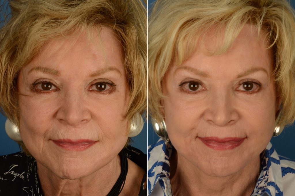 Lip Lift Surgery in Vietnam 1