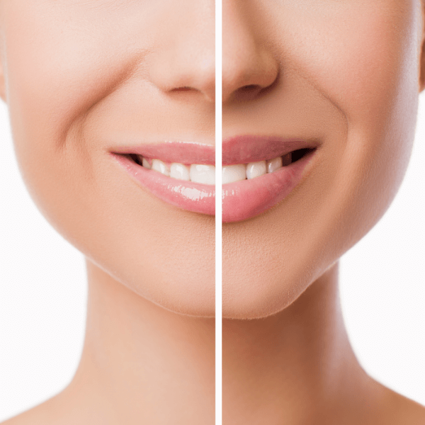 Lip Reduction in Vietnam: Create a More Balanced and Refined Smile 4 Lip Reduction in Vietnam 2